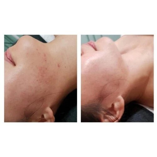 DM Cell - Organic Bio Seacil Exfola Peel Treatment Kit - Image 3