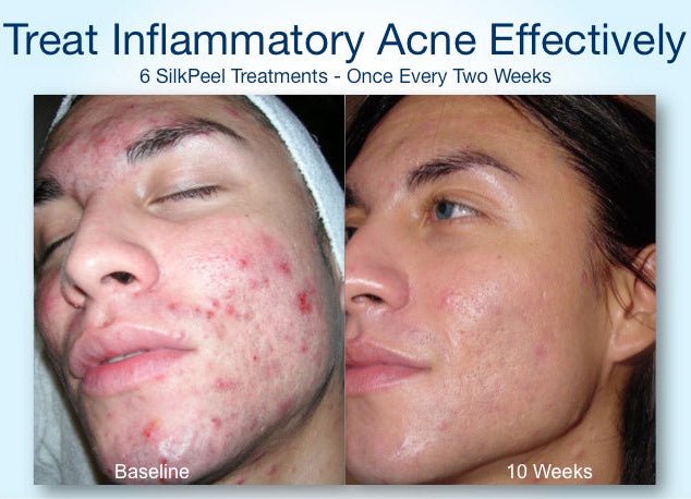 OR`JADE Silky Peel (AHA 30%) - Image 2