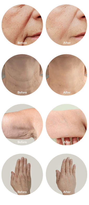 Ultrahilo H + L - 32mg(H-HA) + 32mg(L-HA) / 2mL - Image 5